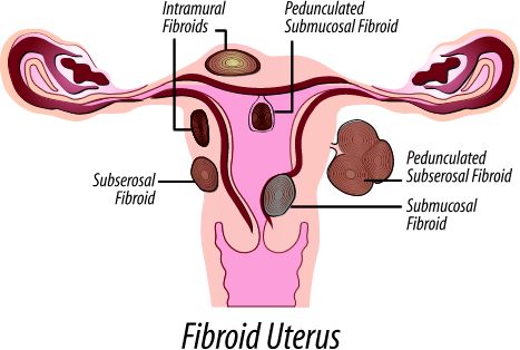 Most of the symptoms of fibroids are so minor that they are dismissed ...